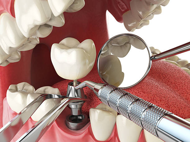 Best Emergency Dental Care for Abscessed Tooth in Cornwall On Hudson, NY